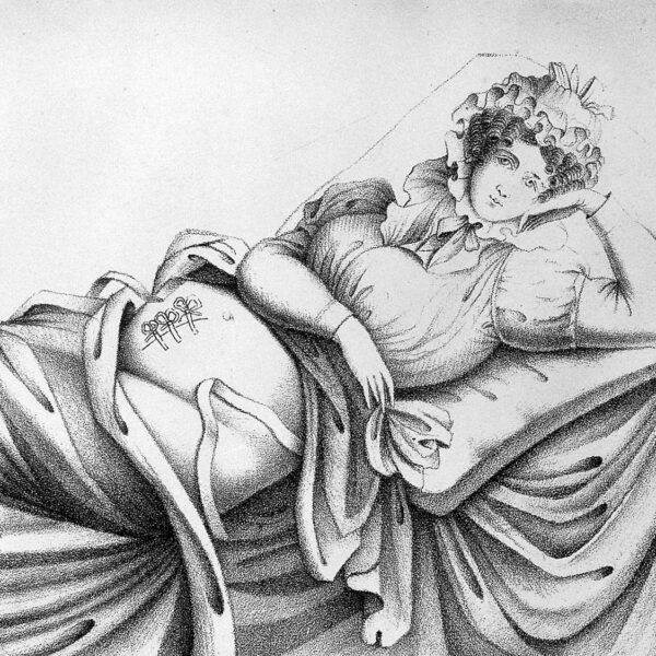 Schwarz-weiß Lithografie einer liegenden Frau mit einer Kaiserschnitt-Narbe